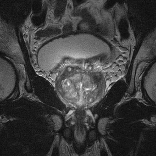 transverse T2-weighted image