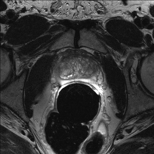 transverse T2-weighted image