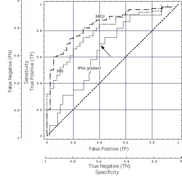 ROC constructed for PSA time gradient as test parameter and MRI/MRSI as reference standard